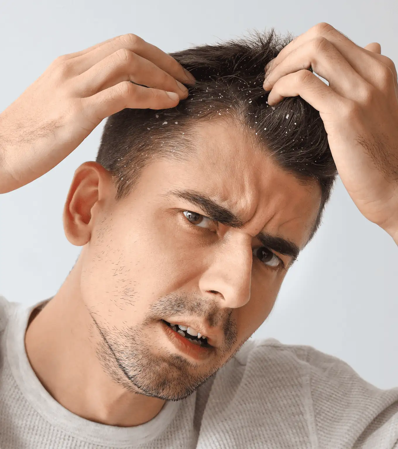 Dandruff And Seborrheic Dermatitis